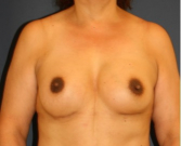 Feel Beautiful - Breast Augmentation 153 - After Photo